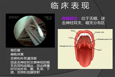 舌咽神经痛的特点