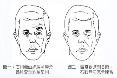 面神经炎你了解吗?