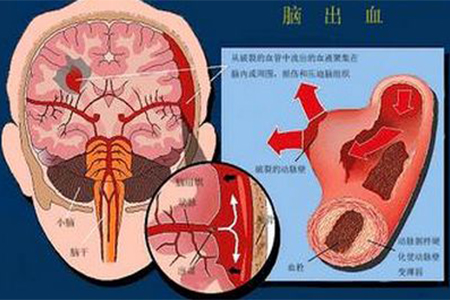 脑出血
