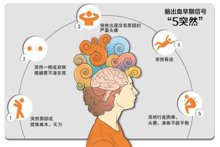 脑出血的五个突然信号