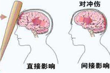 脑外伤后遗症的五大因素